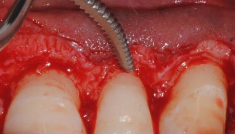 牙冠延长术及唇系带切除术——沈阳牙医王玉楼