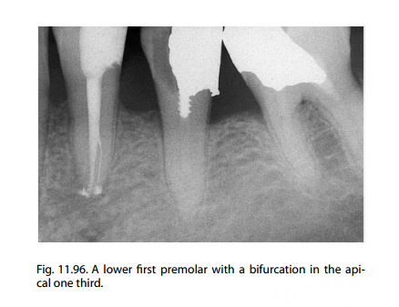 很多教科书中的图片是2个根管,分叉在根中或者根尖1/3处.