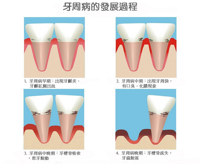 孕妇牙周病严重可致流产